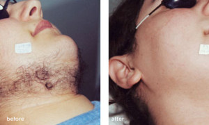 laser-hair-removal-before-after-female 1