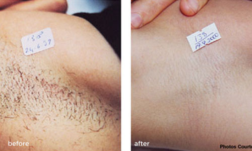 laser-hair-removal-before-after-female 3