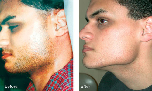 laser treatment for chin hair removal