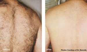 laser-hair-removal-before-after-men 3