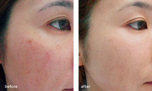 laser-thread-vein-removal Before and after 1