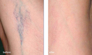 laser-thread-vein-removal B & after 2