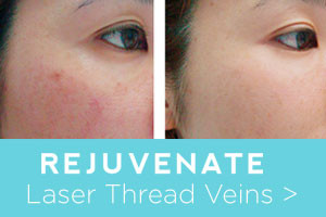 Rejuvenate before and after laser thread vein removal