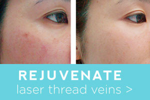 Rejuvenate before and after thread veins
