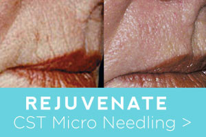 Rejuvenate before and after micro needling