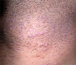 rejuvenate advanced skin clinic ingrown hair