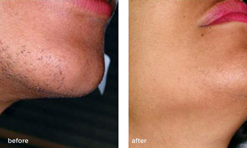 Laser Hair Removal Treatments Before & After Photos